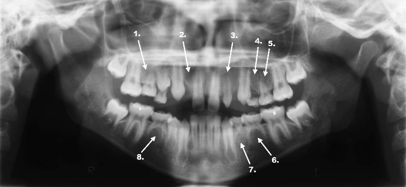 Oligodontia 59_001.jpg